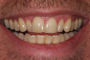 Teeth Before Inman Aligner