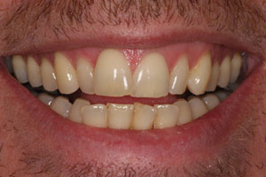 Teeth Before Inman Aligner