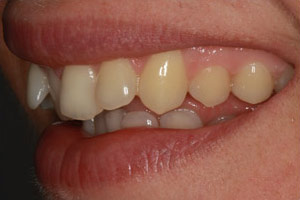 Teeth Before Inman Aligner
